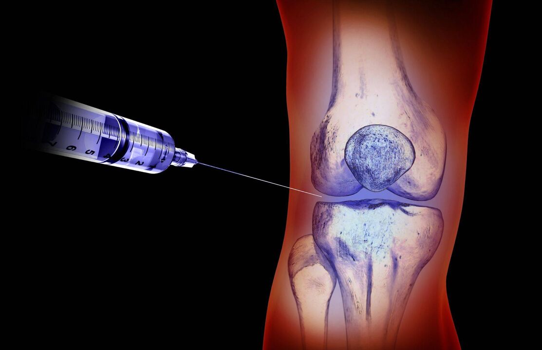 inxeccións intraarticulares para a artrose