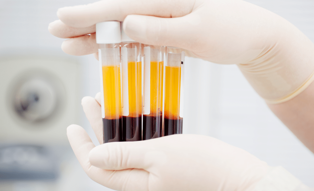 Plasma rico en plaquetas para terapia PRP para artrose